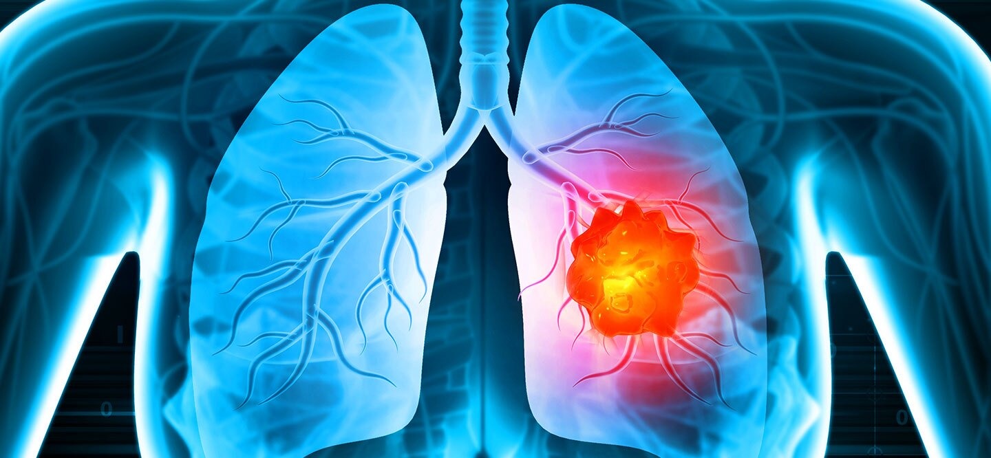 West Bengal’s Lung Cancer Rate Soars to 14%, Doubling National Average of 6%